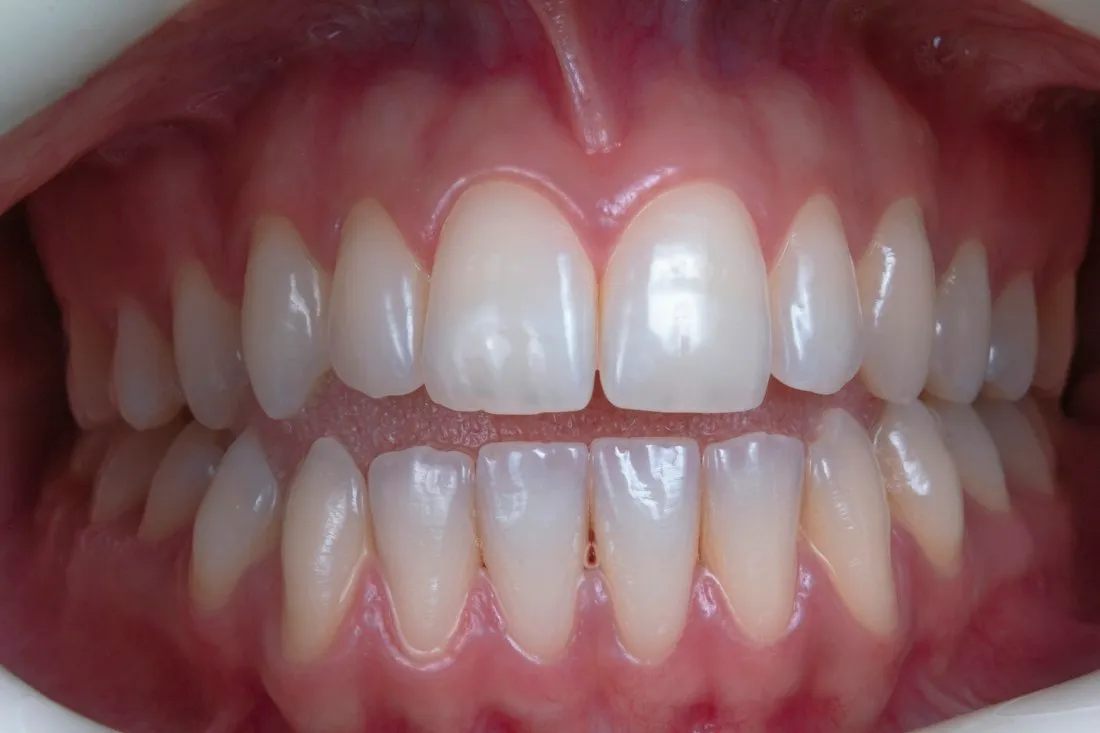 Clinical close-up of healthy pink gums and well-aligned upper and lower teeth