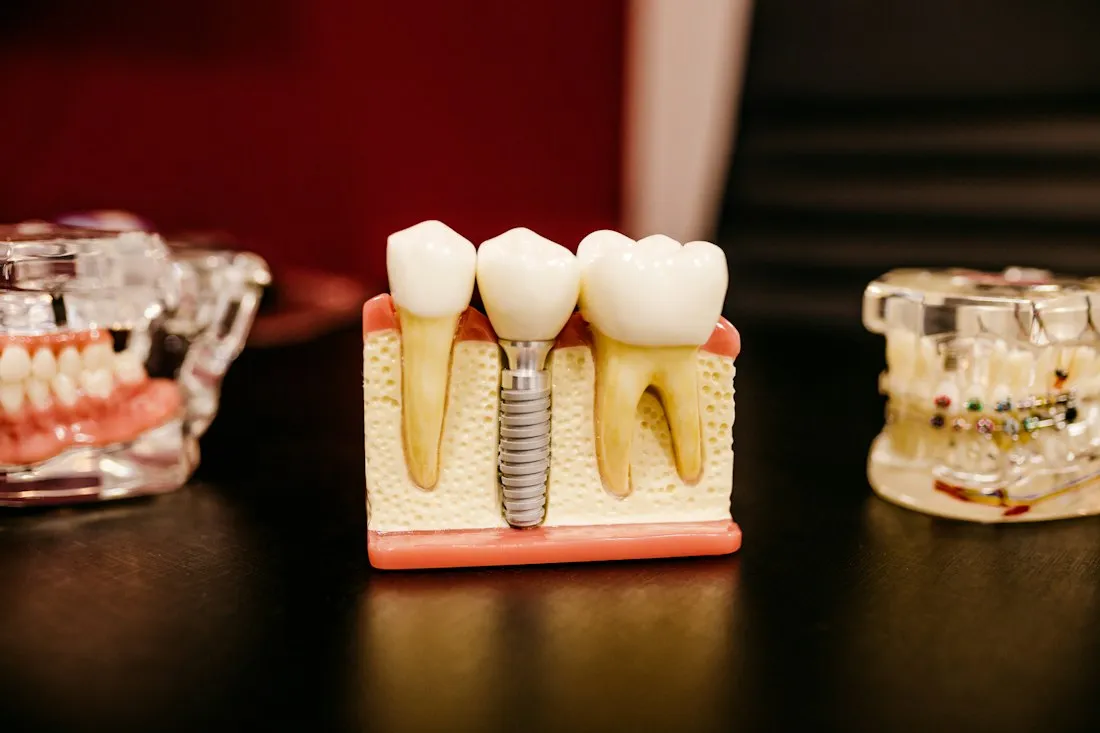 Anatomical dental model showing a titanium implant fixture set in bone beside natural teeth