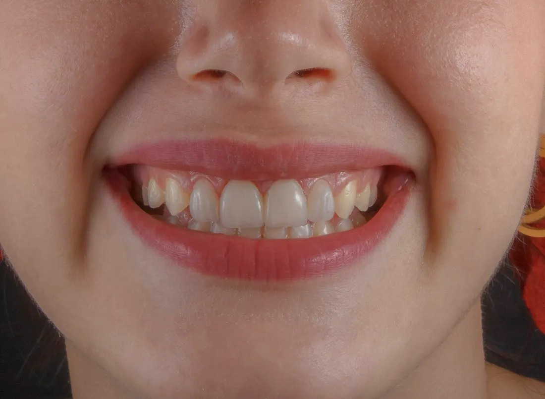 Close-up of a natural smile showing mild yellow tooth discolouration before whitening